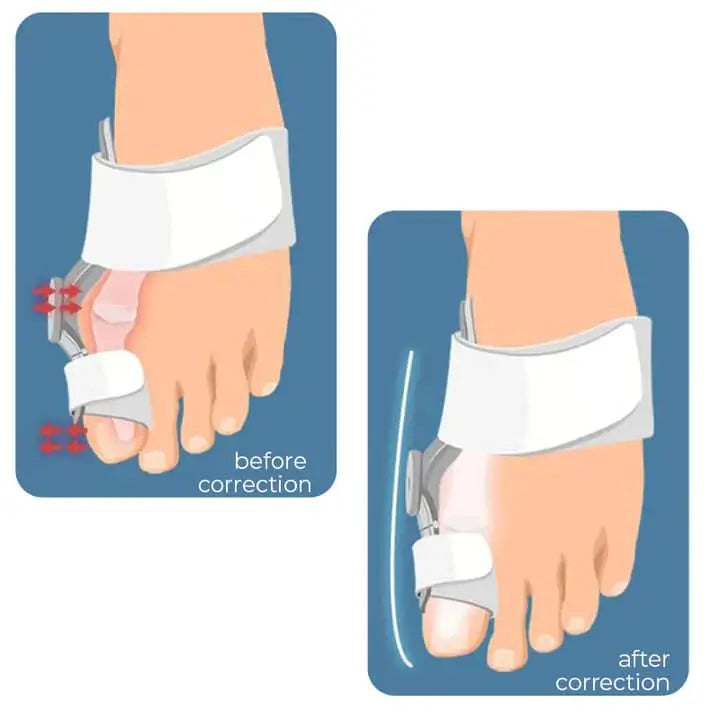 Hallux Valgus Bunion Corrector